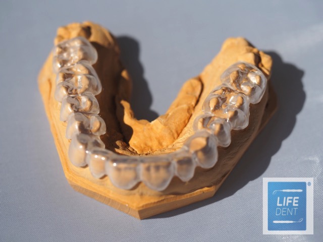 Éjszakai harapásemelő sín